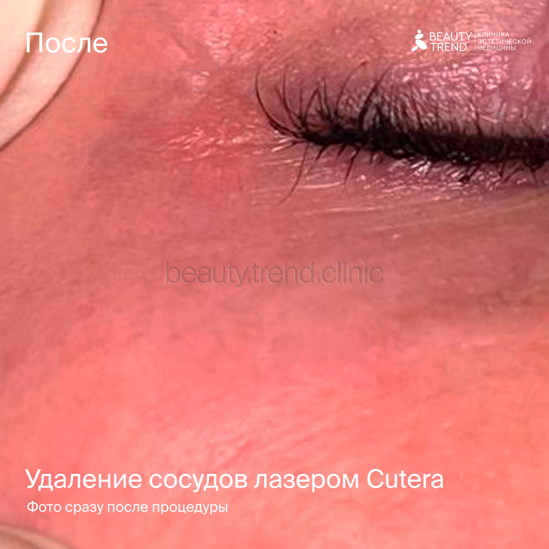 Удаление сосудов Cutera - после 1
